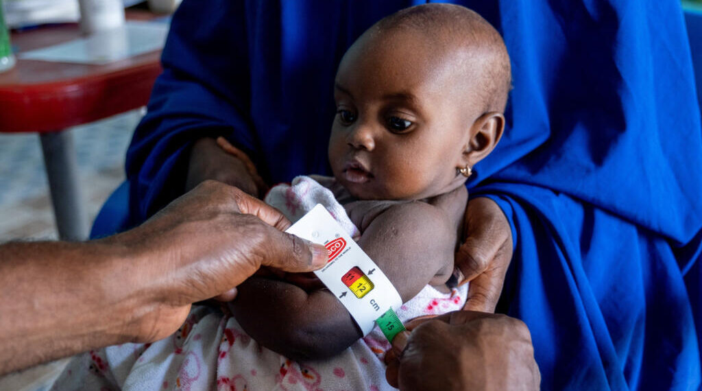 malnutrition in Nigeria