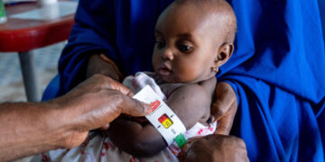 malnutrition in Nigeria