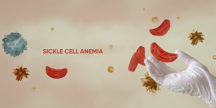 Nigeria Has World’s Highest Sickle Cell Burden with 1.5 Million Children